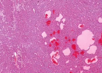 Математика подскажет, как лечить рак мочевого пузыря