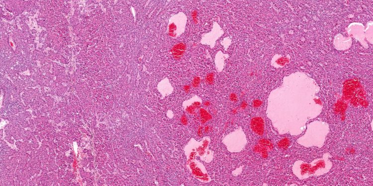 Математика подскажет, как лечить рак мочевого пузыря