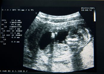 Госдума готовится объявить войну абортам в России