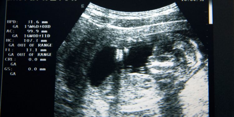 Госдума готовится объявить войну абортам в России