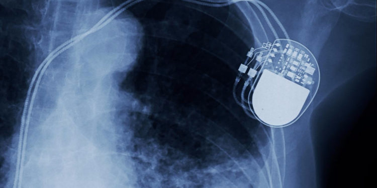 Обнаружен смертельно опасный баг в сотнях тысяч используемых кардиостимуляторов