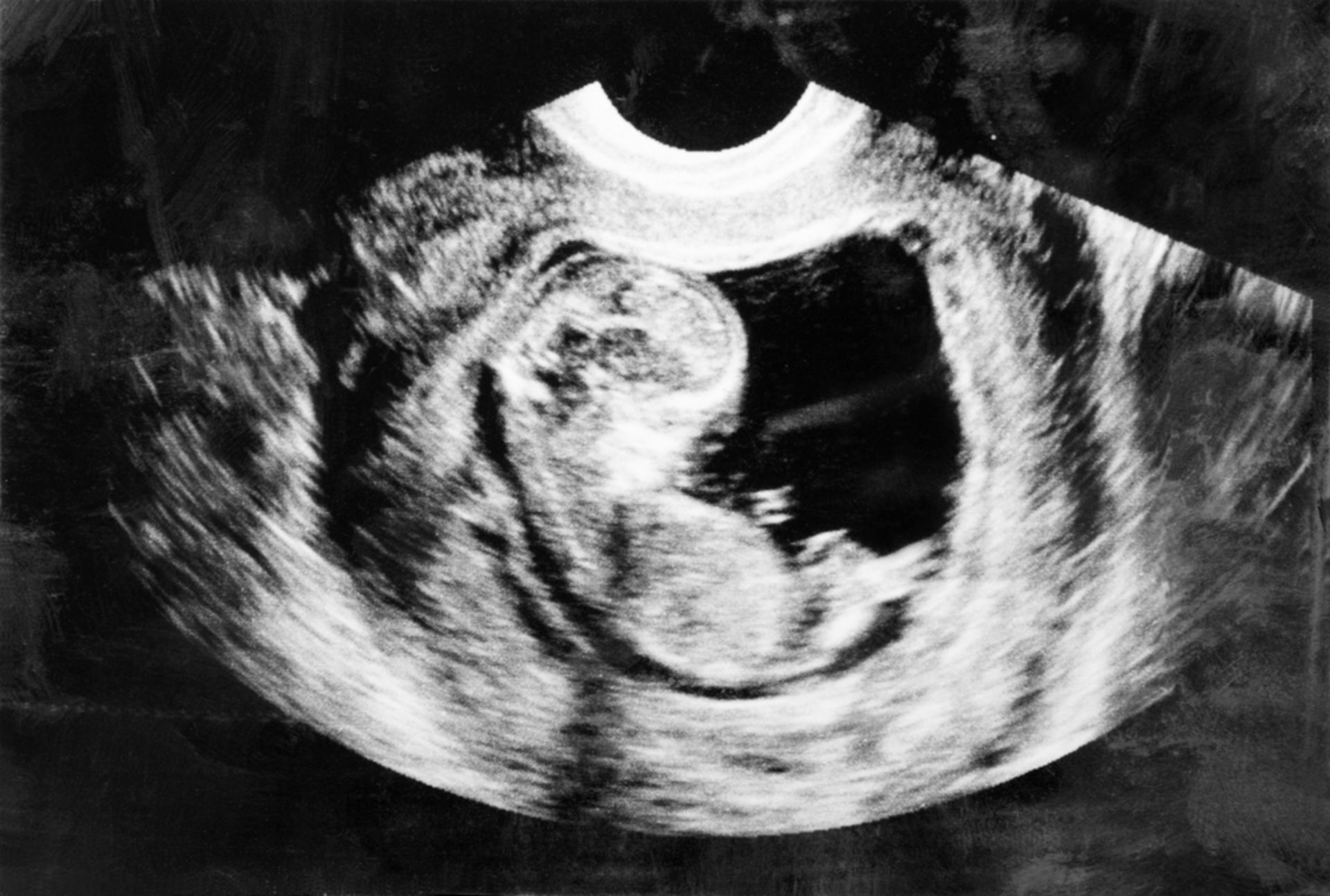 Беременность 3 5 года. Эмбрион 5 месяцев беременности УЗИ. УЗИ 3 месяца беременности. Эмбрион на 2 месяце беременности УЗИ. Снимок УЗИ на 3 месяце беременности.